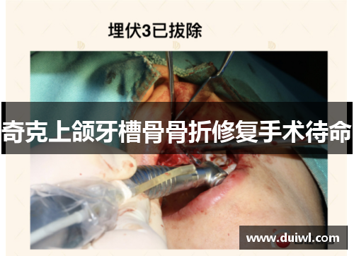 奇克上颌牙槽骨骨折修复手术待命